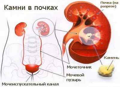 Камені в нирках у жінок: симптоми, ознаки та лікування