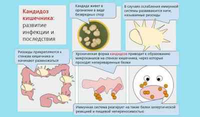 Кандидоз кишечника: симптоми і лікування захворювання