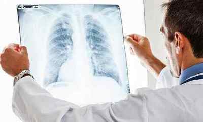 Кандидоз легенів: симптоми, причини і лікування