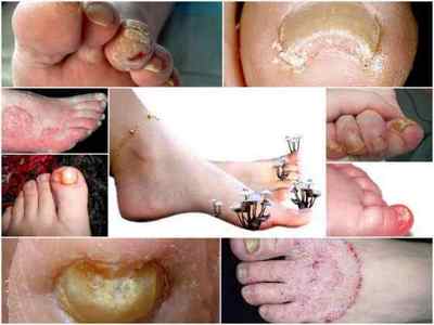 Кандидоз нігтів на ногах: причини, симптоми, лікування, профілактика