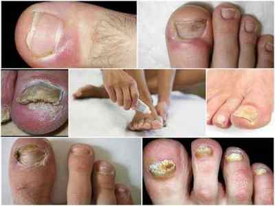 Кандидоз нігтів на ногах: причини, симптоми, лікування, профілактика