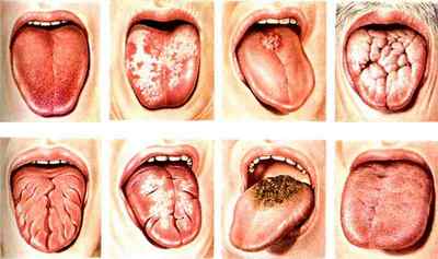 Кандидоз порожнини рота: симптоми і лікування