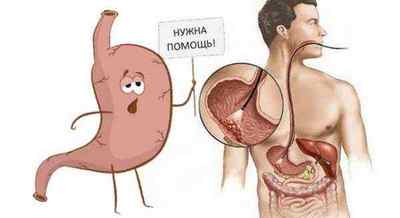 Кандидоз шлунка: причини розвитку та шляхи зараження, симптоми, як лікувати