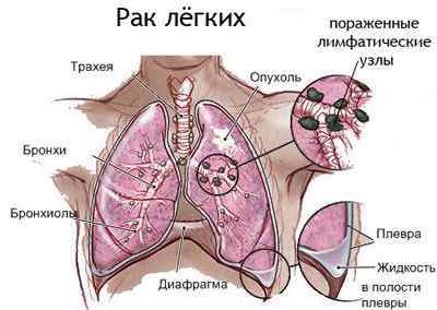 Карцинома легенів: що це таке, прогноз життя