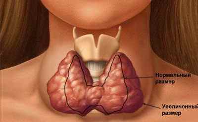 Кашель при щитовидці: симптоми, причини, лікування