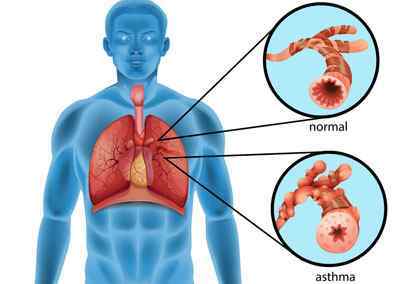 Кашлевая форма бронхіальної астми: ознаки, симптоми, лікування