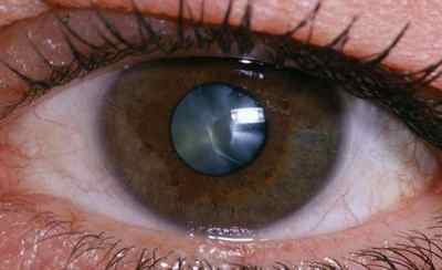 Катаракта і глаукома: що це таке, ознаки на ранніх стадіях, чим відрізняються, профілактика