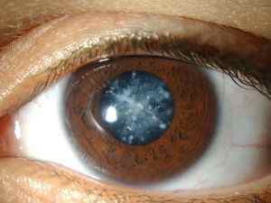 Катаракта очі: що це таке, причини помутніння кришталика, симптоми, лікування і профілактика