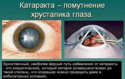 Катаракта очі: що це таке, причини помутніння кришталика, симптоми, лікування і профілактика