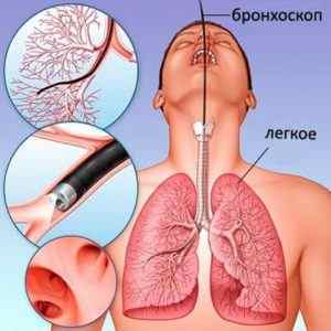 Кавернозний туберкульоз легенів: що це таке, симптоми, лікування
