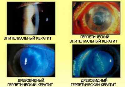 Кератит: симптоми і лікування запалення рогівки ока, види захворювання (вірусний, акантамебного, грибковий)