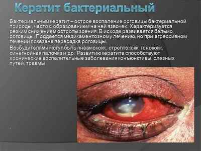 Кератит: симптоми і лікування запалення рогівки ока, види захворювання (вірусний, акантамебного, грибковий)
