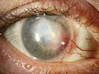 Кератопатія рогівки ока: лікування, види (бульозна, стрічкоподібна, точкова)