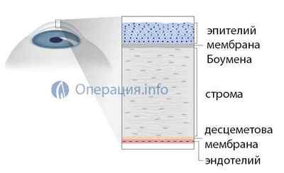Кератопластика (операція з пересадки рогівки ока) - підготовка, хід, реабілітація