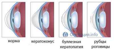 Кератопластика (операція з пересадки рогівки ока) - підготовка, хід, реабілітація