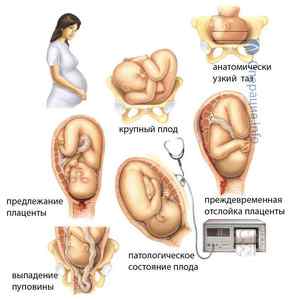 Кесарів розтин: суть операції, показання, плюси і мінуси, проведення, наслідки
