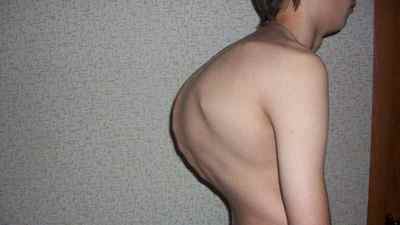 Кіфоз грудного відділу хребта: що таке, симптоми і лікування в домашніх умовах | Ревматолог
