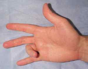 Клацали палець (стенозуючий лігаментит) на руці: лікування без операції в домашніх умовах народними зас | Ревматолог