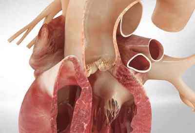 Клапанний стеноз аорти у новонароджених