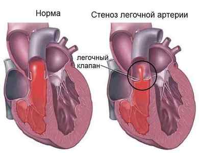 Клапанний стеноз легеневої артерії у новонародженого