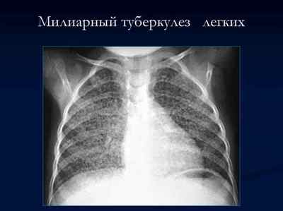 Клінічна класифікація туберкульозу легенів