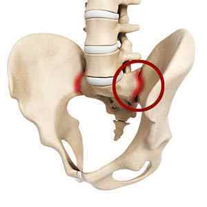 Клубово-крижовий суглоб: анатомія і біль в крижово-бугорной звязці, лікування звязок крижів | Ревматолог