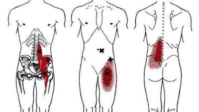 Клубово-поперековий мяз: функції і анатомія, що робити якщо болить, синдром клубово-поперекового мяза, вправи | Ревматолог