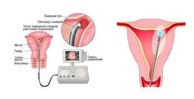 Коли варто робити абляцию ендометрія матки: особливості процедури, наслідки