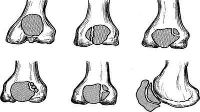 Колінні чашечки у дітей: коли зявляються у новонароджених, народжуються без колінних чашечок, коли формується, рухається | Ревматолог