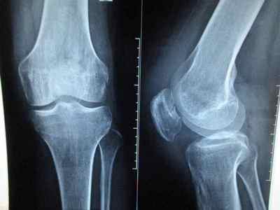 Коліно не розгинається до кінця: що робити якщо заклинило коліно і не випрямити ногу, причини болю в коліні, розгиначі | Ревматолог