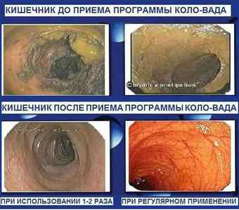 Коло Вада від глистів: інструкція із застосування в лікуванні паразитів