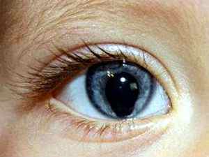 Колобома райдужки ока (вроджена і набута): як діагностувати, лікування зорового нерва