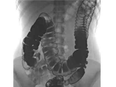 Колоноптоз кишечника: що це за патологія, її симптоми і лікування