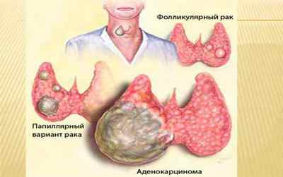 Ком і біль в горлі при щитовидній залозі: симптоми