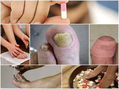 Комплексне лікування грибка нігтів на ногах