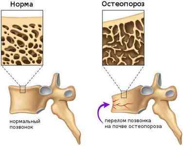 Компресійний перелом поперекового відділу хребта