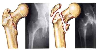 Компресійно-осколковий перелом хребта: лікування та операція, багатоуламковий закритий перелом зі зміщенням, інвалідність | Ревматолог