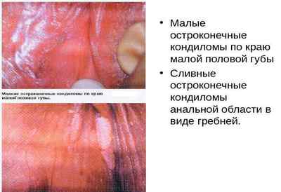 Кондиломи на статевих губах: способи видалення