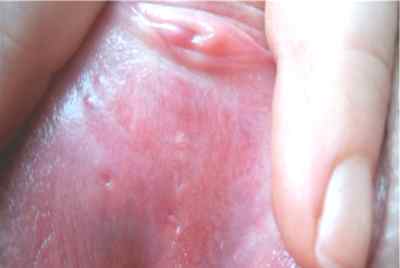 Кондиломи на статевих губах: способи видалення