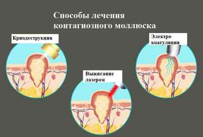 Контагіозний молюск в інтимних місцях: причини, симптоми і лікування
