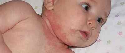 Контактний дерматит у дітей: лікування, чим небезпечний