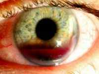Контузія ока: наслідки контузії очного яблука, класифікація, ступеня (1 2 і 3)