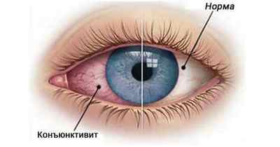 Конюнктива ока: що це таке, симптоми і лікування патологій