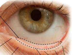 Конюнктивальний мішок ока: де знаходиться нижня і верхня порожнина, фото, функції