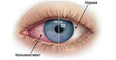 Конюнктивіт очей у дорослих: симптоми, як визначити хворобу, від чого буває, ускладнення
