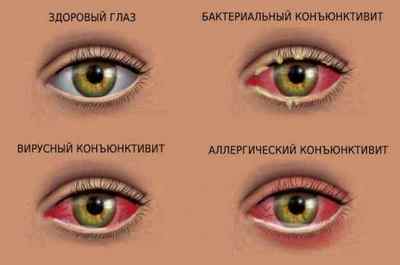 Конюнктивіт очей у дорослих: симптоми, як визначити хворобу, від чого буває, ускладнення