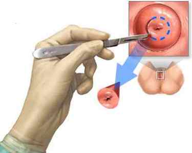 Конізація шийки матки: види операції, як проходить, післяопераційний період