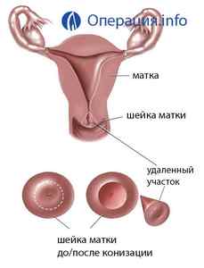 Конізація шийки матки: види операції, як проходить, післяопераційний період