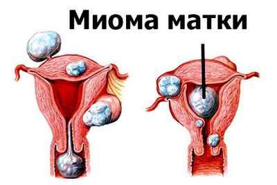 Корінь лопуха при міомі матки: застосування, рецепти
