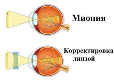 Deficiențele vizuale: Ce este Hipermetropia? Simptomele, cauzele și tratamentul